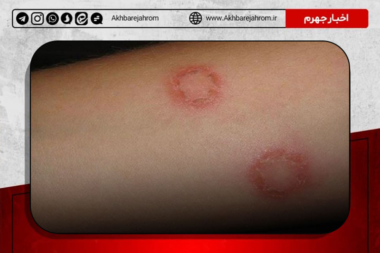 وضعیت حاد بیماری سالک (لیشمانیوز پوستی) در شهرستان جهرم