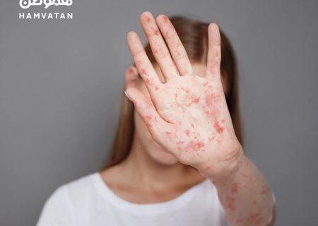 هر آنچه باید درباره بیماری سرخک بدانید!