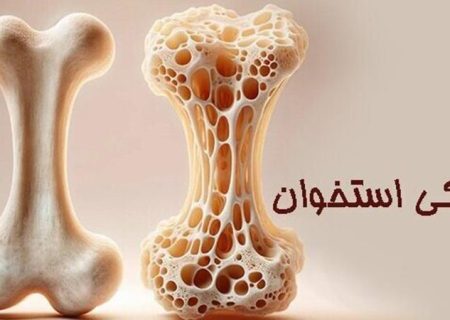 پوکی استخوان؛ بیماری خاموش اما قابل پیشگیری