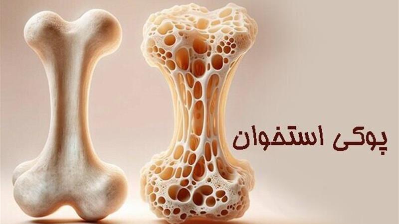 پوکی استخوان؛ بیماری خاموش اما قابل پیشگیری
